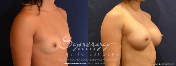 Before & After Breast Augmentation Case 554 View #4 View in Austin, TX
