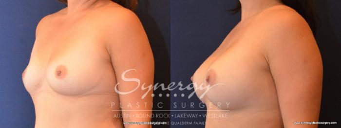 Before & After Breast Augmentation Case 559 View #2 View in Austin, TX