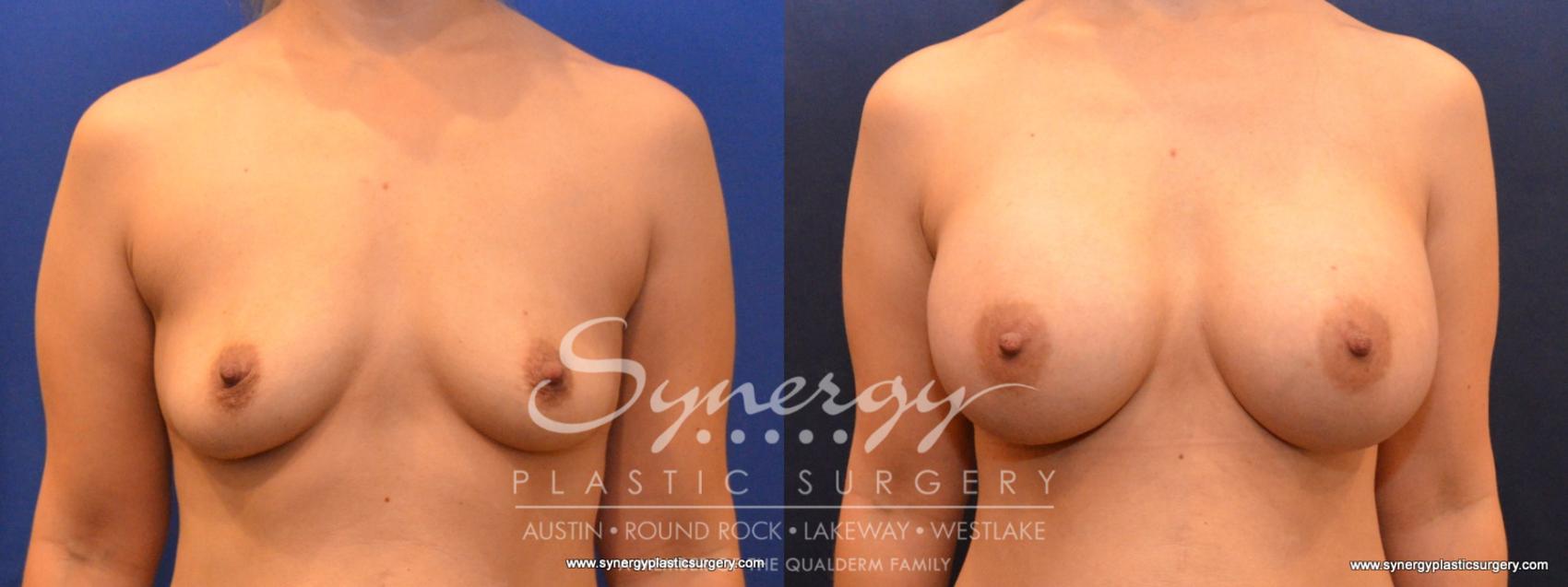 Before & After Breast Augmentation Case 560 View #1 View in Austin, TX