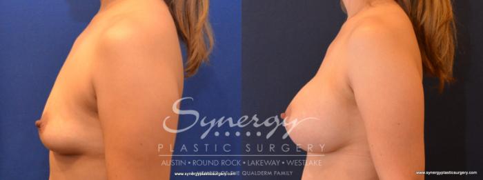 Before & After Breast Augmentation Case 560 View #3 View in Austin, TX
