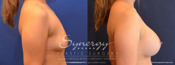 Before & After Breast Augmentation Case 560 View #5 View in Austin, TX