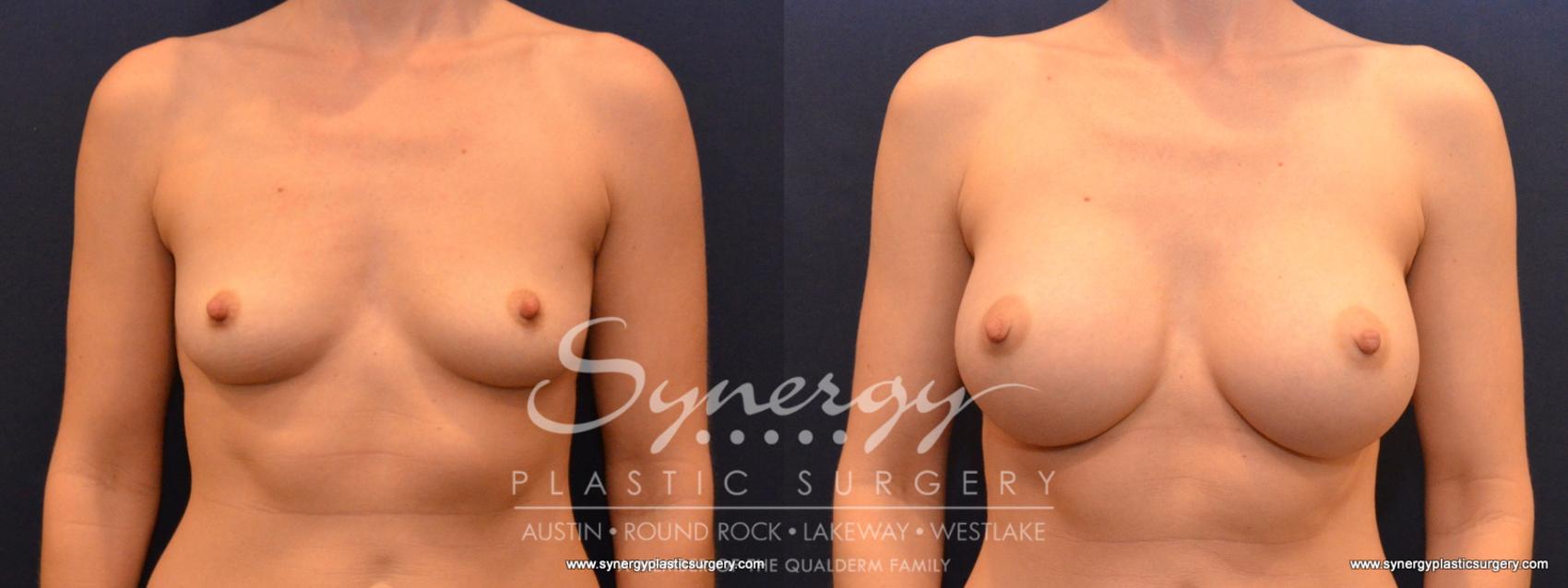 Before & After Breast Augmentation Case 562 View #1 View in Austin, TX