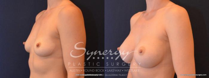 Before & After Breast Augmentation Case 562 View #2 View in Austin, TX