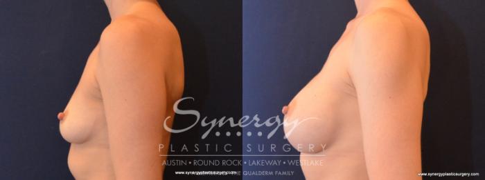 Before & After Breast Augmentation Case 562 View #3 View in Austin, TX