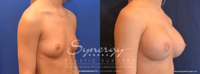 Before & After Breast Augmentation Case 563 View #4 View in Austin, TX