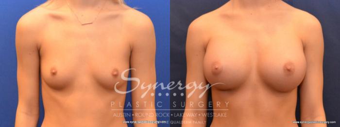 Before & After Breast Augmentation Case 563 View #5 View in Austin, TX
