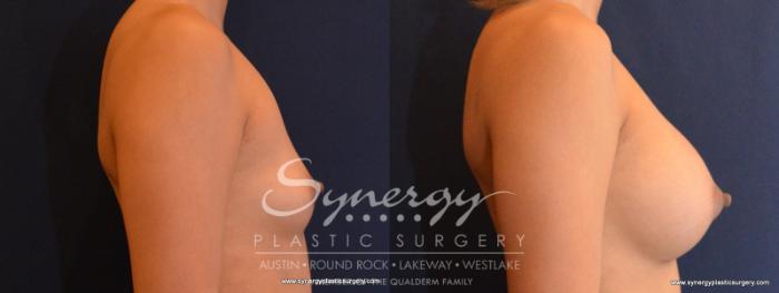 Before & After Breast Augmentation Case 564 View #3 View in Austin, TX