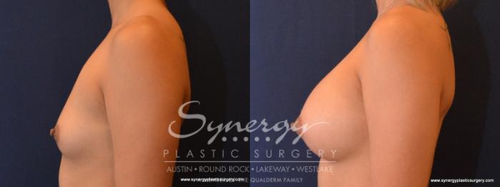 Before & After Breast Augmentation Case 564 View #4 View in Austin, TX