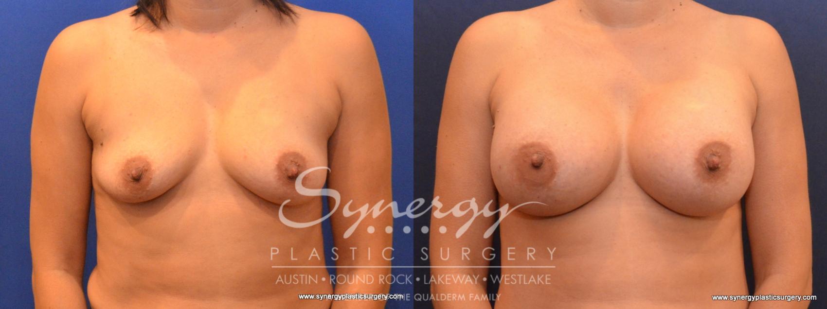 Before & After Breast Augmentation Case 567 View #1 View in Austin, TX