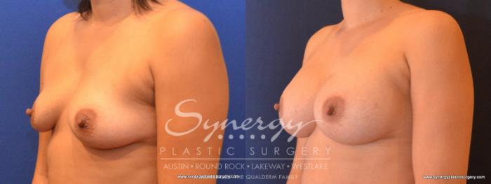 Before & After Breast Augmentation Case 567 View #2 View in Austin, TX