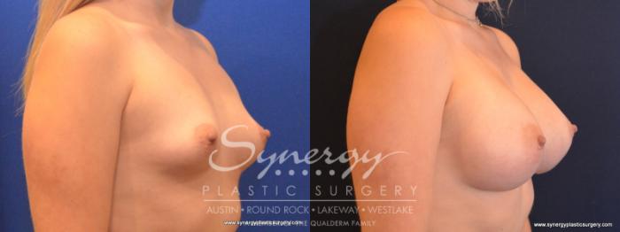 Before & After Breast Augmentation Case 569 View #3 View in Austin, TX