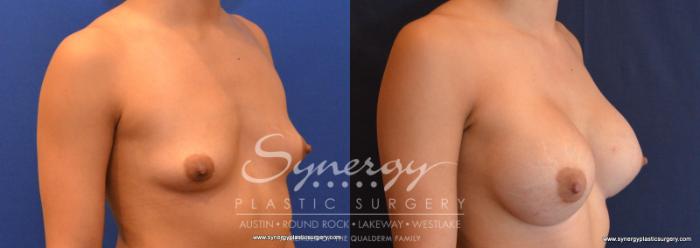 Before & After Breast Augmentation Case 572 View #4 View in Austin, TX