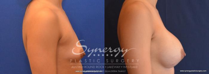 Before & After Breast Augmentation Case 572 View #5 View in Austin, TX
