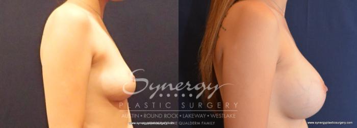 Before & After Breast Augmentation Case 580 View #3 View in Austin, TX