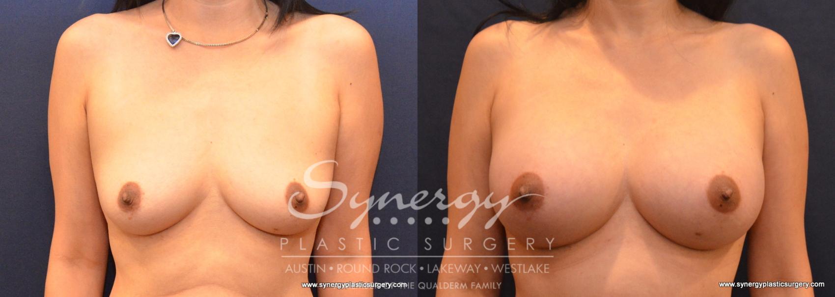 Before & After Breast Augmentation Case 586 View #1 View in Austin, TX