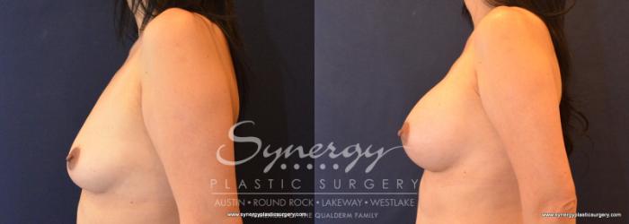 Before & After Breast Augmentation Case 586 View #3 View in Austin, TX