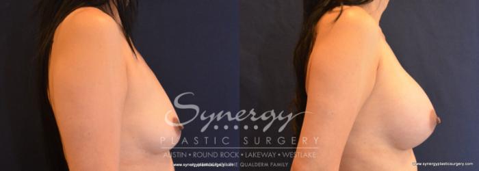 Before & After Breast Augmentation Case 586 View #5 View in Austin, TX
