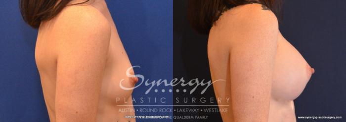 Before & After Breast Augmentation Case 587 View #4 View in Austin, TX