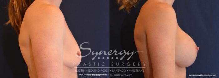 Before & After Breast Augmentation Case 589 View #4 View in Austin, TX