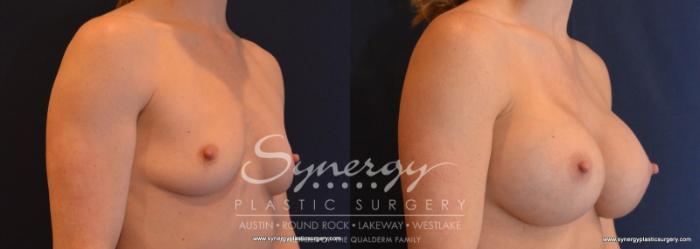 Before & After Breast Augmentation Case 589 View #5 View in Austin, TX