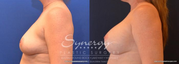 Before & After Breast Augmentation Case 590 View #5 View in Austin, TX