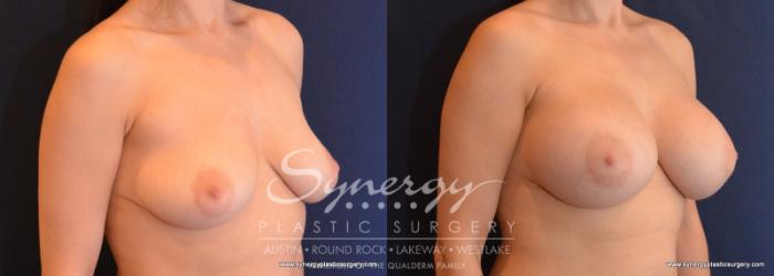 Before & After Breast Augmentation Case 597 View #2 View in Austin, TX