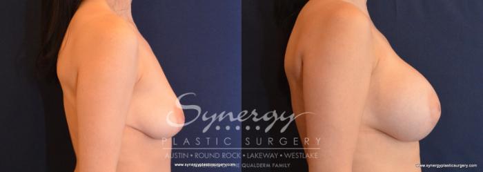 Before & After Breast Augmentation Case 597 View #3 View in Austin, TX
