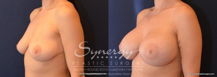 Before & After Breast Augmentation Case 597 View #4 View in Austin, TX
