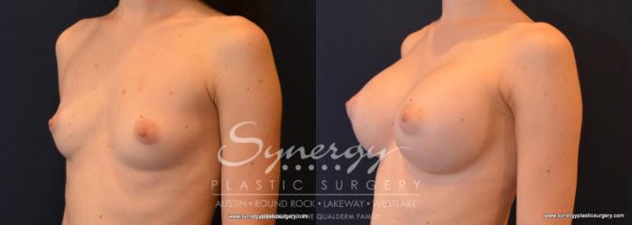Before & After Breast Augmentation Case 598 View #2 View in Austin, TX