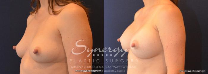 Before & After Breast Augmentation Case 602 View #4 View in Austin, TX