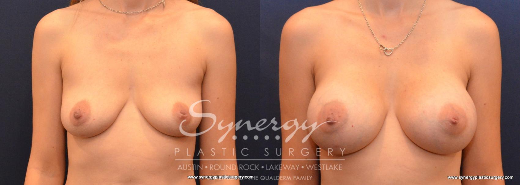 Before & After Breast Augmentation Case 604 View #1 View in Austin, TX