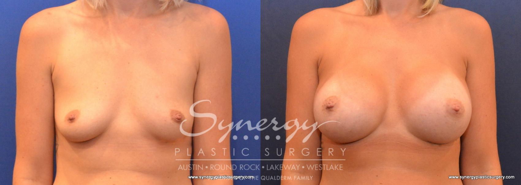 Before & After Breast Augmentation Case 606 View #1 View in Austin, TX