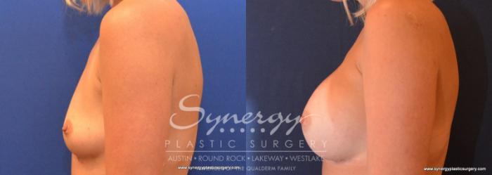 Before & After Breast Augmentation Case 606 View #3 View in Austin, TX
