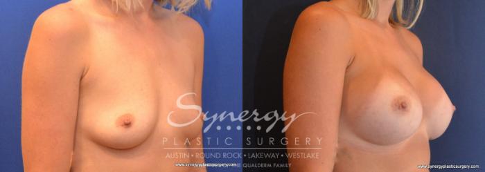 Before & After Breast Augmentation Case 606 View #4 View in Austin, TX