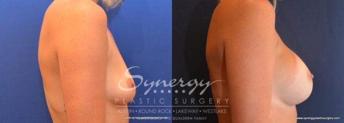 Before & After Breast Augmentation Case 606 View #5 View in Austin, TX