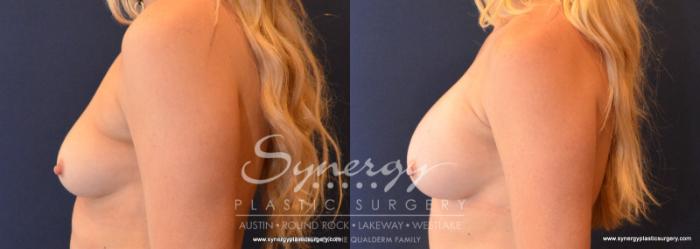 Before & After Breast Augmentation Case 609 View #3 View in Austin, TX