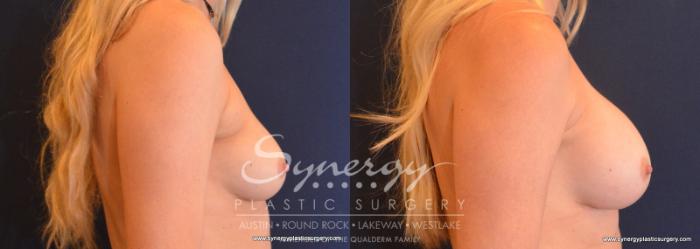 Before & After Breast Augmentation Case 609 View #5 View in Austin, TX