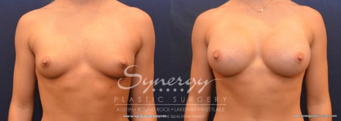 Before & After Breast Augmentation Case 611 View #1 View in Austin, TX