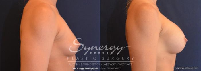 Before & After Breast Augmentation Case 611 View #3 View in Austin, TX