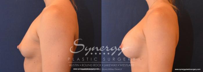 Before & After Breast Augmentation Case 611 View #5 View in Austin, TX