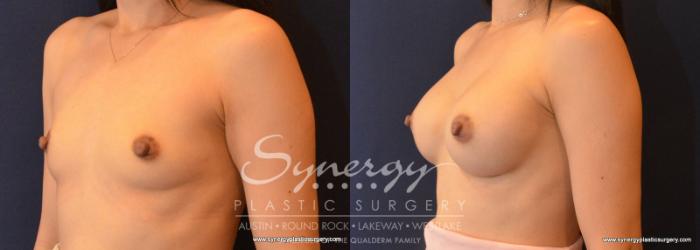 Before & After  Case 613 View #2 View in Austin, TX