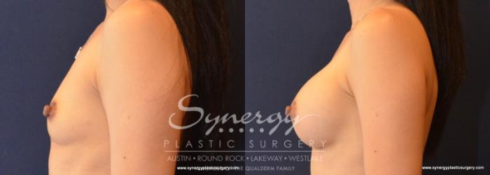 Before & After  Case 613 View #3 View in Austin, TX