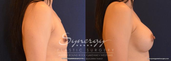 Before & After  Case 613 View #5 View in Austin, TX