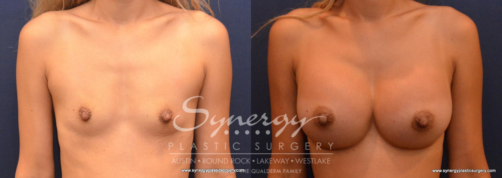 Before & After Breast Augmentation Case 614 View #1 View in Austin, TX