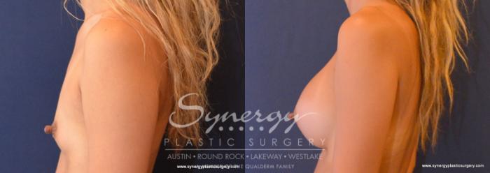 Before & After Breast Augmentation Case 614 View #2 View in Austin, TX