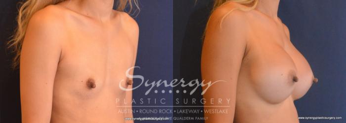 Before & After Breast Augmentation Case 614 View #3 View in Austin, TX