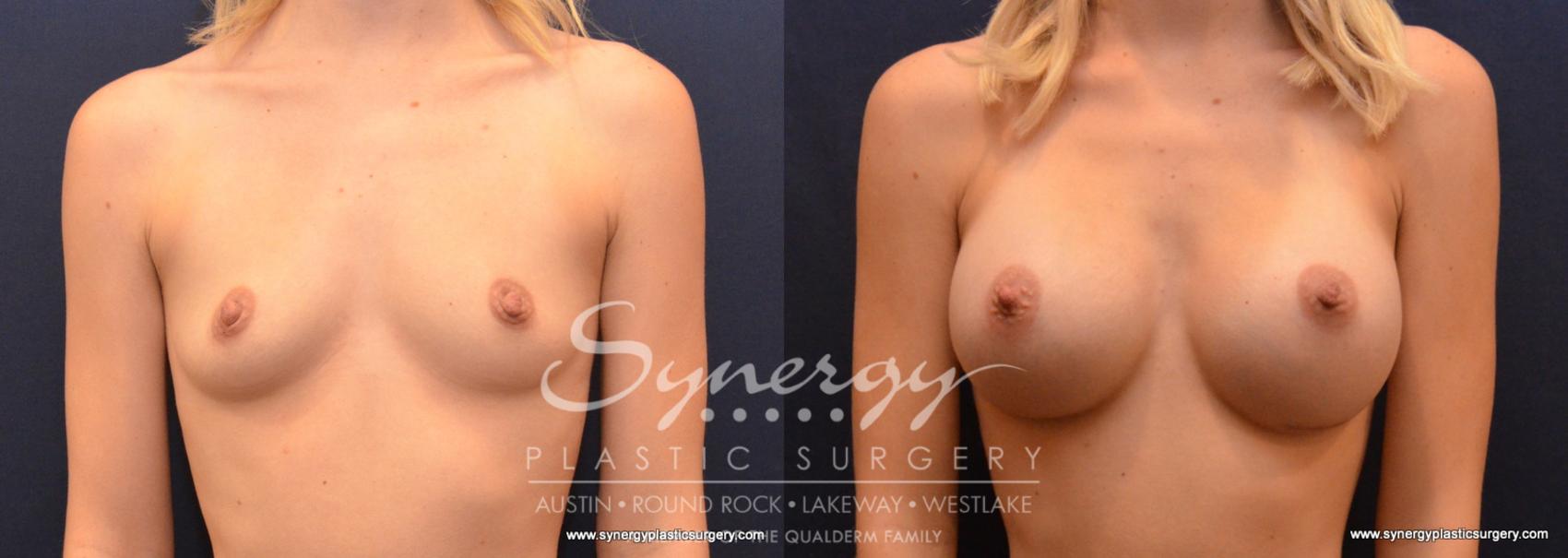 Before & After Breast Augmentation Case 615 View #1 View in Austin, TX