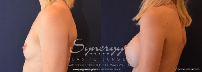 Before & After Breast Augmentation Case 615 View #3 View in Austin, TX