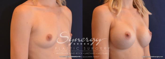 Before & After Breast Augmentation Case 615 View #4 View in Austin, TX