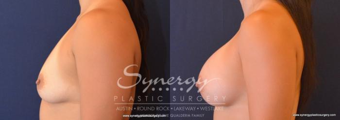 Before & After Breast Augmentation Case 616 View #3 View in Austin, TX